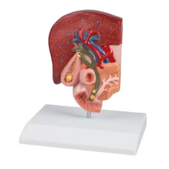 Modelo de cálculo biliar Erler Zimmer