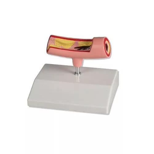 Modelo de la arteria Erler Zimmer