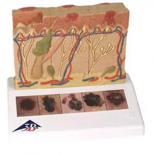 Modelo de cáncer de piel 3B scientific J15